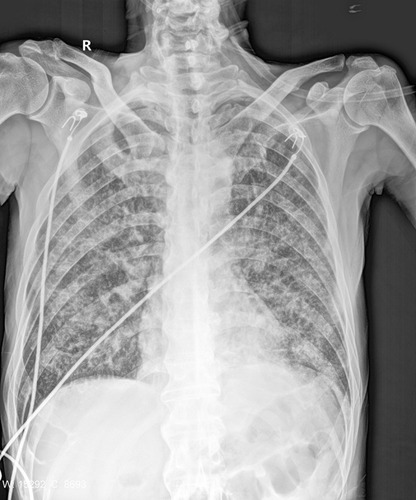 Figure 1 Chest X-ray. Chest diagnostic radiograph showed a slight increase and thickening of the texture of both lungs, with increased diffuse patch density. The boundary was fuzzy, and no obvious consolidation shadow was seen in the rest of the lungs.