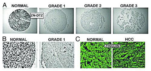 Figure 2. In situ zinc staining of normal vs. HCC tissues. (A) Dithizone staining showing black ZnDTZ stain of high levels of cellular zinc in normal parenchyma, and loss ZnDTZ in HCC. (B) Enlargement of normal liver and Grade1 HCC to show the ZnDTZ throughout the parenchymal hepatocyte component; and loss of zinc stain in well-differentiated hepatoma cells. (C) Zinquin stain showing high fluorescence by zinc in normal hepatocytes and marked decrease in hepatoma cells. (Taken and modified from ref. Citation14.)