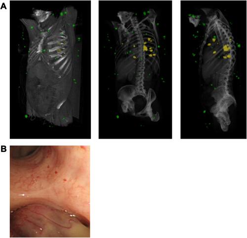 Figure 3 Pulmonary and cutaneous cylindromas visualised radiologically and endoscopically. (A) Spatial location of cutaneous CCS tumours seen on a CT with contrast indicated in green, and pulmonary CCS tumours indicated in yellow. Adapted from (B) Intra bronchial CCS tumour visualised during bronchoscopy. Adapted with permission from Brown SM, Arefi M, Stones R, et al. Inherited pulmonary cylindromas: extending the phenotype of CYLD mutation carriers. Br J Dermatol. 2018;179:662–668. © 2018 The Authors. British Journal of Dermatology published by John Wiley & Sons Ltd on behalf of British Association of Dermatologists.Citation41