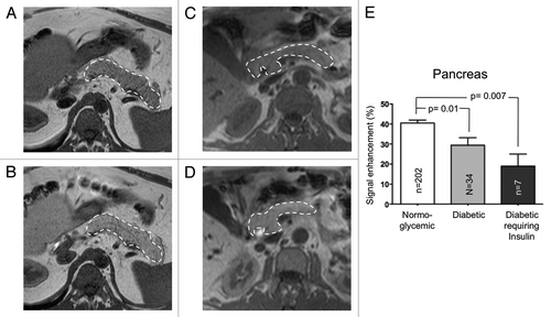 Figure 2. The MRI signal enhancement of pancreas is enhanced by manganese. T1-weighted magnetic resonance imaging showing the pancreas (area limited by the dashed line) before (A, C) and 20 min after Mn-DPDP infusion (B, D) of a normoglycemic (A, B) and a type 2 diabetic patient (C, D). In both patients, the MRI signal of pancreas was enhanced by the manganese infusion. E) This enhancement was significantly higher in normoglycemic than in type 2 diabetic patients. Data are mean + SEM signal enhancement, expressed as % of the signal evaluated prior to the manganese infusion.