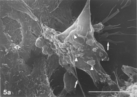 FIG. 5 10 mM AAP, 48 h. (5a) Note irregular amorphous cytoplasmic body undergoing self-morsellation but still adhering to distended perikaryon, an 8-µm-long gap (hollow arrow) disclosing from underneath extensive system of cytoskeleton, filopodia (arrows) and microvilli with distorted morphology (arrowheads). (5b) two self-morselled cytoplasmic bodies (A) in a late phase of separation from distended cell with an adjacent cell-derived debris (D) just before detachment from the perikaryon. Note many rounding cells and vast areas debrided from cells (5c). Bar: (a), 10 µm; (b) 10 µm; (c) 100 µm.