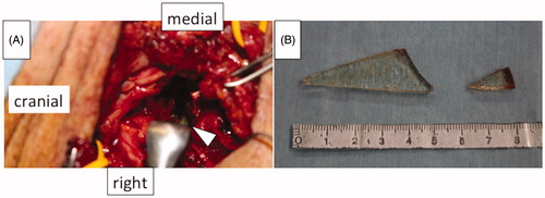 Figure 3. (A) The right neck exploration. The arrow head shows the edge of the glass. (B) The retrieved glass pieces. The larger one was located between the transverse processes of C4 and C5.