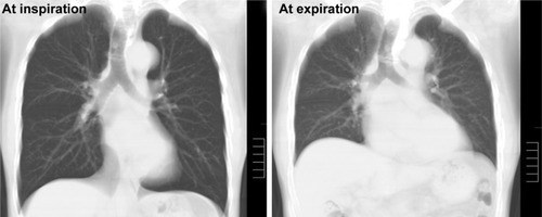 Figure 3 Reconstructed coronal CT images of a 72-year-old male smoker with mild COPD (FEV1/FVC=66%, LAV%=13%).