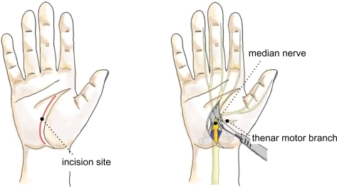 Figure 2 Open carpal tunnel release.