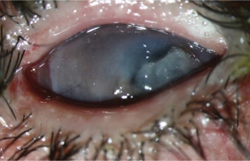 Figure 8 Corneal melting, 6 months later.