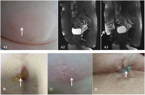 Figure 2. A 46-year-old woman with UFs but without abdominal scar: (A1) superficial burn (I°) of skin with erythema and edema measuring about 15 cm × 10cm after FUAS immediately; sagittal view of T2WI, (A1) no abnormal signals in the abdominal wall before FUAS; (A3) hyperintense signals after FUAS (indicated by the arrowhead); a 33-year-old woman with UFs and an abdominal scar: (B) superficial partial-thickness burn (S-II°) of skin with blisters measuring about 2 cm × 2cm 1 day after FUAS (indicated by the arrowhead); a 47-year-old woman with UFs but without abdominal scar:(C) deep partial-thickness burn (D-II°) of skin with cheesy, white-to-red appearance measuring about 3 cm × 3cm after FUAS immediately (indicated by the arrowhead); a 31-year-old woman with UFs and an abdominal scar: (D) full-thickness burn (III°) of skin with grayish and wrinkled appearance measuring about 1.5 cm × 1cm after FUAS immediately (indicated by the arrowhead).