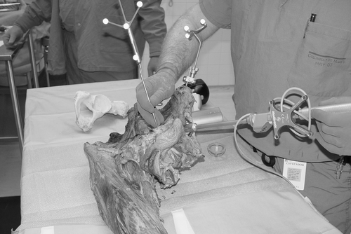 Figure 2. Cadaveric pelvis placed supine for imageless referencing of the pubic tubercle. Note the cup inserter placed for measuring cup position.