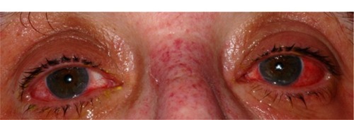 Figure 1 Patient with acute Stevens-Johnson syndrome, at the time of initial presentation to hospital and before initiation of treatment, showing conjunctival injection in both eyes.