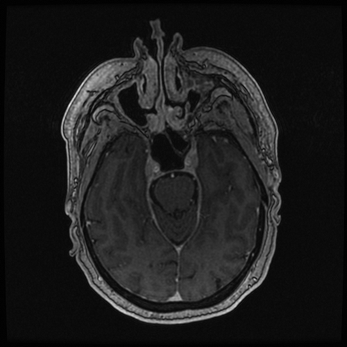 Figure 5. Six-month surveillance imaging: MRI brain T1 sequence with contrast. There is interval decrease in pathologic enhancement involving the right Meckel’s cave mass with new enhancement within left Meckel’s cave