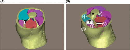Figure 9. 3D reconstruction of the tumor region for patient 5. (A) Superior view of the entire 3D model of the tumor region: “T” indicates the tumor. (B) Superior view with some structures cut away to show the spatial relationships between the tumor and peritumoral structures: (1) sartorius muscle; (2) gracilis; (3) popliteal vessels; (4) vastus medialis; (5) subcutaneous fat. “F” indicates the femur. The relationships between the tumor and peritumoral structures are easily obtained in three dimensions.