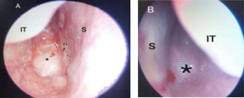 Figure 1 Posterior choanae via endoscope prior to surgery (A) Right nasal passage (B) Left nasal passage S: Septum; IT: Inferior turbinate; *Atretic choanae.