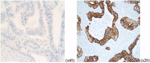Figure 1. HER3 expression, IHC, grade 0 and grade 3 detected by HER3 monoclonal rabbit antibody (Abcam, SP71 ErbB, ab 93739, dil 1:800).