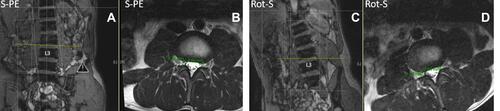 Figure 15 Coronal image of S-PE subject with axial slice at yellow line commensurate with endplate demonstrating symmetric caliber NF at the cut level (A and B). Same subject in rotated position. Coronal view (C) demonstrates axial slice (yellow line) in without adjusting for vertebral rotation, resulting in asymmetric NF with Rot-S axial view (D).