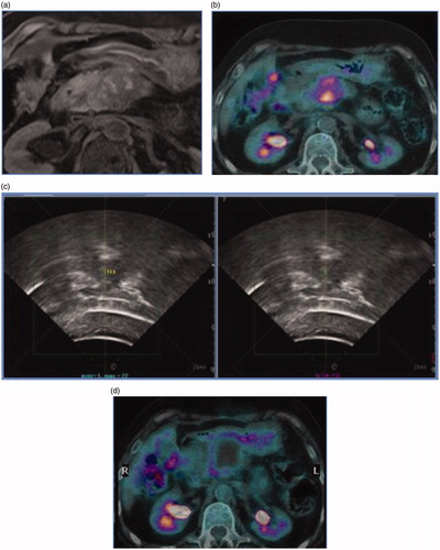 Figure 1. Case of a patient with symptomatic pancreatic adenocarcinoma treated with high intensity focused ultrasound. (a) Magnetic resonance Imaging demonstrating pathologic pancreatic mass. (b) PET/CT scan demonstrating high FDG uptake of the pancreatic tumor. (c) Treatment with US-guided high-intensity focused ultrasound. (d) PET/CT scan after treatment demonstrating lack of FDG uptake in the ablated area.