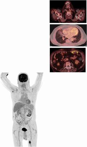 Figure 3. PET-CT, Juni 2019. Muscular foci are clearly in regression
