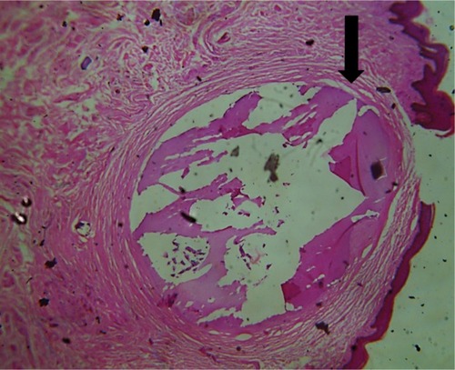 Figure 2 Photomicrograph of a case of idiopathic scrotal calcinosis showing intraluminal calcifications, shown by the black arrow (hematoxylin and eosin, 100×).