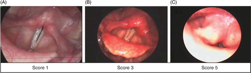 Fig. 1.  High-speed film scores with 4,000 pictures/sec of the larynx including the arytenoid regions. Score 1 indicates a normal arytenoid region and normal vocal folds. Score 3 indicates a moderate oedema of the arytenoid region and normal vocal folds. Score 5 indicates almost total closure of the larynx due to arytenoid oedema (Citation4).