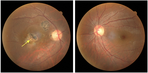 Figure 4 Color fundus Photograph of the second case. (Left) The posterior pole of the right eye showed multiple retinochoroidal scars in the parafoveal area and yellowish exudate adjacent to the previous hyperpigmented scar (yellow arrow) represented recurrent infection. (Right) The fundus of the left eye was unremarkable.