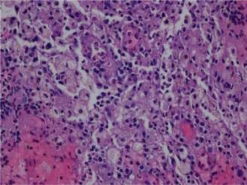 Figure 5 Sheets of xanthoma cells and scattered hemosiderin- laden macrophages, neutrophils, lymphocytes, plasma cells, and erythrocytes. The xanthoma cells have small, round nuclei and abundant clear or vacuolated cytoplasm (hematoxylin-eosin; original magnification: ×400).