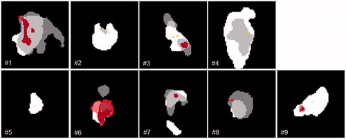 Figure 2. Axial slides of GTVRec (white); VH (dark grey) and VM (red) and the PO-R (yellow) for each analyzed patient. In images with more than one PO-R all shown points have the same distance to the surface of GTVRec. Due to the localization of the PO-R, not all subvolumes are visible in each image.