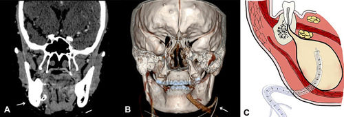 Figure 3 An example of the MIVD device in the patient’s body. (A) Contrast-enhanced CT scan showed the location of the MIVD device in the patient body (anterior coronal position) (A, the white arrow). (B) Corresponding 3D reconstruction image of the patient with the MIVD device (posterior coronal position) (B, the white arrow). (C) An illustration of the MIVD device in the abscess cavity.