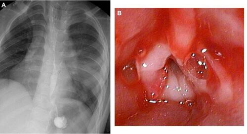 Figure 2 Corrosive oesophagitis: (A) radiological image (B) endoscopic image.