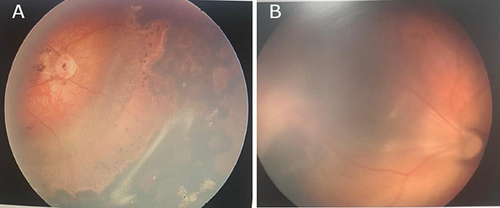 Figure 1 (A) Fundus view of the right eye showing Stage 4A ROP with macular dragging. (B) Postoperative LSV fundus photo showing flat retina with scleral buckle and peripheral endo-laser.