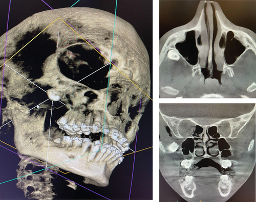 Figure 1. Three-dimensional cone beam computed tomography showing displacement of right maxillary third molar into the infratemporal fossa (Figure 1(a) 3D reconstruction, Figure 1(b) axial view, Figure 1(c) coronal view).