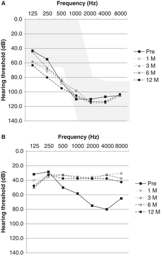 Figure 4. (A) Average audiogram of group 2. The lines indicate preoperative, and 1, 3, 6, and 12 months postoperative audiograms. Note that good hearing preservation could be achieved. (B) Hearing level of group 2 with electric acoustic stimulation (EAS).