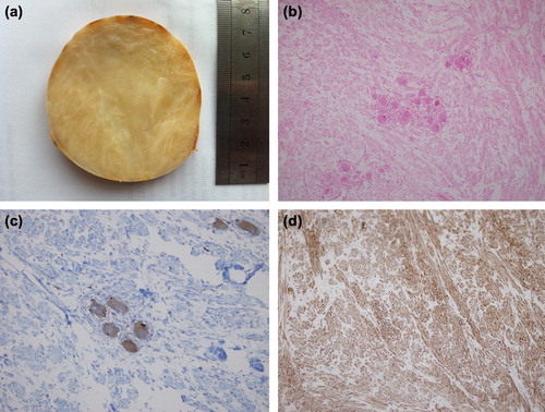 Figure 3. (a) Gross pathological appearance of postoperative right adrenal tumor. It is encapsulated, 9 × 8× 7 cm in dimensions. The tumor shows a whitish grey and gelatinous appearance in the cut surface without evidence of hemorrhage or necrosis. (b) The tumor showing clusters of mature ganglion cells in Schwannian cell dominant stroma (hematoxylin and eosin staining, original magnification × 100). (c) Neoplastic ganglionic cells were positive for synaptophysin (immunoperoxidase staining, × 200). (d) Spindle-shaped Schwannian cells-rich stroma stained positive for S-100 protein (immunoperoxidase staining, × 100).