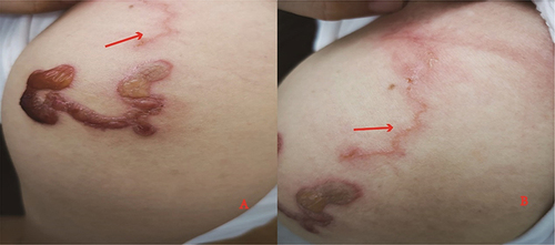 Figure 4 Clinical presentation of the patient after one week of the treatment (A and B) the rash still spread to the proximal part of the left upper arm and left shoulder with red arrows).