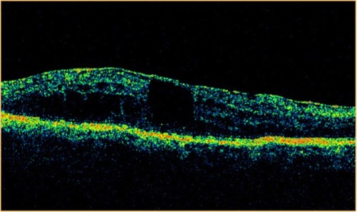 Figure 26 Stratus optical coherence tomography image.