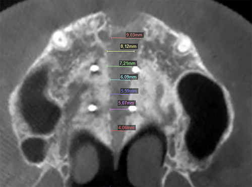 Figure 4 Axial CBCT-slice of the midpalatal suture opening.