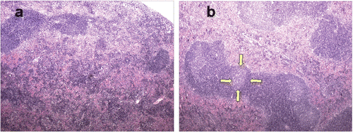 Figure 8. Spleen histology. (a) Spleen from a control group mouse (40×). (b) Spleen from a mouse euthanized 5 days post-HT showing enlarged germinal centres (the yellow arrows outline one such germinal centre). Many follicles appear to be coalescing together.