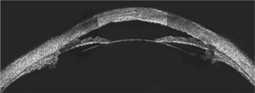 Figure 2 Ultrasound biomicroscopy image using the Humphrey-Zeiss model 840 (San Leandro, CA, USA [50 MHz]) showing a case of sclerocornea with corneal thickening, irregular morphology, and internal hyper-reflectivity.