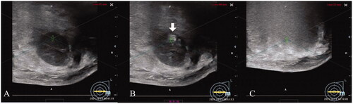 Figure 1. The significant scale changes during HIFU treatment for breast fibroadenoma. A: Pre-HIFU ultrasound showed a hypoechoic breast fibroadenoma. B: Intra-HIFU ultrasound showed a significant hyperechoic scale changes emerging during HIFU (white arrow). C: Post-HIFU ultrasound showed that the significant hyperechoic scale change covered the whole fibroadenoma.