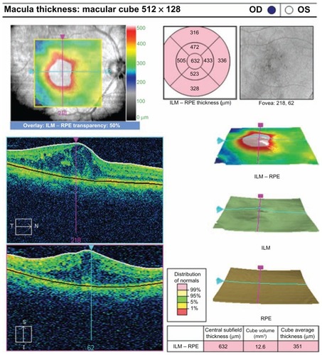 Figure 7 Optical coherence tomograph for a patient in group 2 at the preoperative visit.