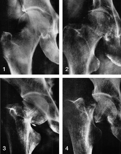 Figure 2. Garden's classification. Garden stages 1–4. Reproduced with permission and copyright © of the British Editorial Society of Bone and Joint Surgery Citation[80];Citation[85]