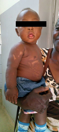 Figure 6 6-Month Follow-up Image: Depicting the thriving infant who survived being buried alive post-birth. Taken during the routine 6-month visit, highlighting normal growth, positive nutritional status, accomplishment of age-appropriate developmental milestones, and visible skin lesion scars.