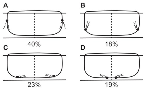 Figure 4 Illustration of respondents’ preference for placing the direction of the tails of the knots: (A) facing away from the ocular surface; (B) facing towards the ocular surface; (C) facing towards the graft–host interface; (D) facing away from the graft–host interface.