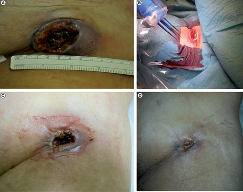 Figure 2. Electrochemotherapy treatment of the inguinal lymph node metastasis. (A) Ulcerating melanoma metastasis before electrochemotherapy treatment. (B) Electrochemotherapy treatment with intralesional cisplatin. (C) The patient had significantly less bleeding 2 weeks after treatment. (D) The ulceration was now almost healed and the bleeding had stopped 6 weeks after treatment.