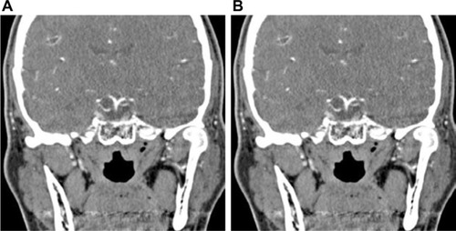Figure 2 Brain angio CT scan’s coronal view (A) and axial view (B).