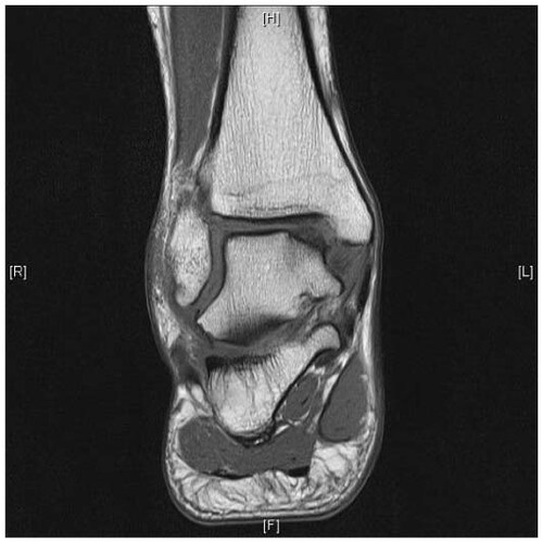 Figure 1 T1 magnetic resonance imaging appearance of a posteromedial osteochondral shoulder lesion.