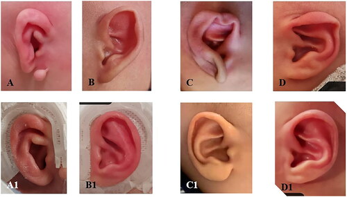 Figure 5. Auricle malformation. (A–D) Before correction, (A1–D1) after correction corresponding to A–D, (A) microtia, structure malformation, (B–D) morphology malformation: (B) flaring ear, (C) ring contraction ear, and (D) lop ear and cryptotia.