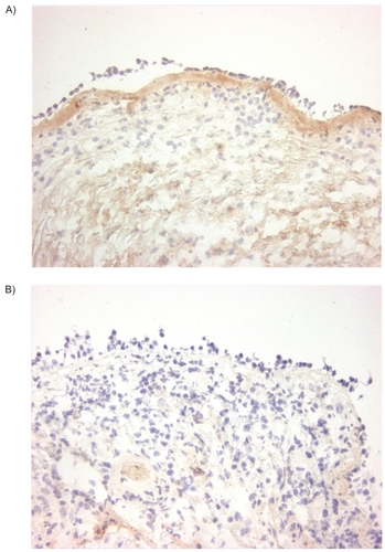 Figure 3 Collagen I staining. Immunohistochemical staining of bronchial biopsies for collagen I (immunoperoxidase, original magnification × 200) showed, a uniform red-brown-stained band beneath the epithelial layer in asthma (A left panel). In contrast to asthma, this is significantly less intense in COPD (p < 0.05, B right panel).