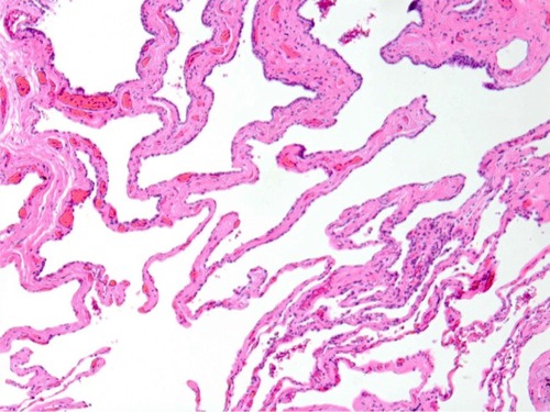 Figure 2 Smoking-associated interstitial fibrosis.