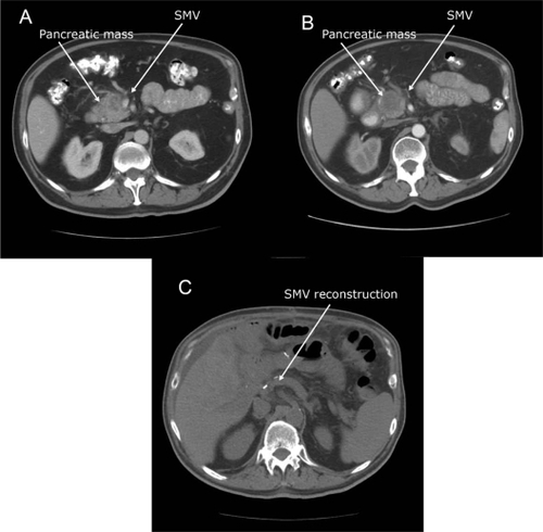 Figure 2 Downstaging with neoadjuvant therapy: 59-year-old man with a 2.2 × 1.8 cm pancreatic head mass found to be pancreatic adenocarcinoma on biopsy A) Pretreatment scan. Note severe SMV impingement, which fits criteria for borderline resectable disease B) Post-treatment scan. The patient was reated with neoadjuvant capecitabine 1500 mg po bid and concurrent radiation. The SMV is less confined; the pancreas mass remains similar in size. C) Post-operative scan. The patient underwent pancreaticoduodenectomy with jugular SMV reconstruction.