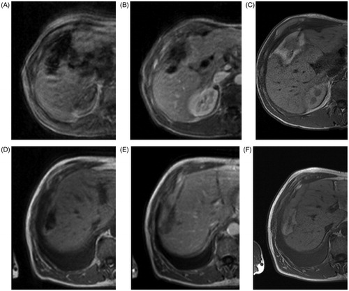 Figure 5. Comparison between the last MRI T1-based treatment monitoring image, contrast-enhanced MRI obtained immediately after LITT and the contrast-enhanced MRI obtained 24 h after the treatment. (A–C) A 57-year-old patient with a hepatic metastasis in segment 4b. (D–F) Liver metastasis from colorectal cancer in segment 8 from a 69-year-old patient. (A) and (D) T1 weighted GRE sequences (FLASH, TE/TR 4.8/119, FA 90°, TA 2 s) demonstrate imaging of the progress of LITT treatment just before the end of the ablation procedure. Although image A is affected by motion of the surrounding organs, signal loss can clearly be demarcated due to the thermally induced cell damage. (B) and (E) T1 weighted contrast-enhanced GRE sequences after LITT (FLASH, TE/TR 4.8/119, FA 90°, TA 2 s) depict an area of enlarging hypointensity; a slight benign peripheral enhancement according to the reactive tissue reaction can also be demarcated [Citation10]. (C) and (F) Contrast-enhanced T1 weighted GRE (FLASH, TE/TR 101/1000 ms, FA 150°, TA 1 s/slice) show an extended hyperintense coagulation zone. In both cases a reposition of the applicator was performed to maximise the ablation zone. (C) depicts a larger coagulation area due to the two laser fibres used during the treatment, whereas (F) shows a rather ellipsoid shaped area. The puncture track is still visible as a thin dark hypointensity within the necrotic area.