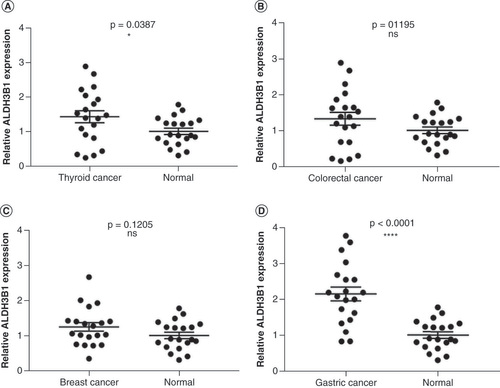 Figure 2. Expressions of serum aldehyde dehydrogenase 3B1 in thyroid cancer, colorectal cancer, breast cancer and gastric cancer patients. (A) Differential expression of ALDH3B1 in the serum of thyroid cancer patients and healthy donors. (B) Differential expression of ALDH3B1 in the serum of colorectal cancer patients and healthy donors. (C) Differential expression of ALDH3B1 in the serum of breast cancer patients and healthy donors. (D) Differential expression of ALDH3B1 in the serum of gastric cancer patients and healthy donors.