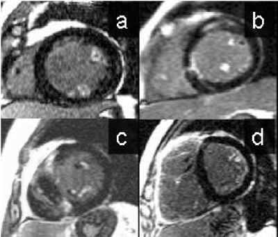 Figure 1. (a) Sarcoid, (b) Myocarditis, (c) Hypertrophic cardiomyopathy, (d) Systemic sclerosis.